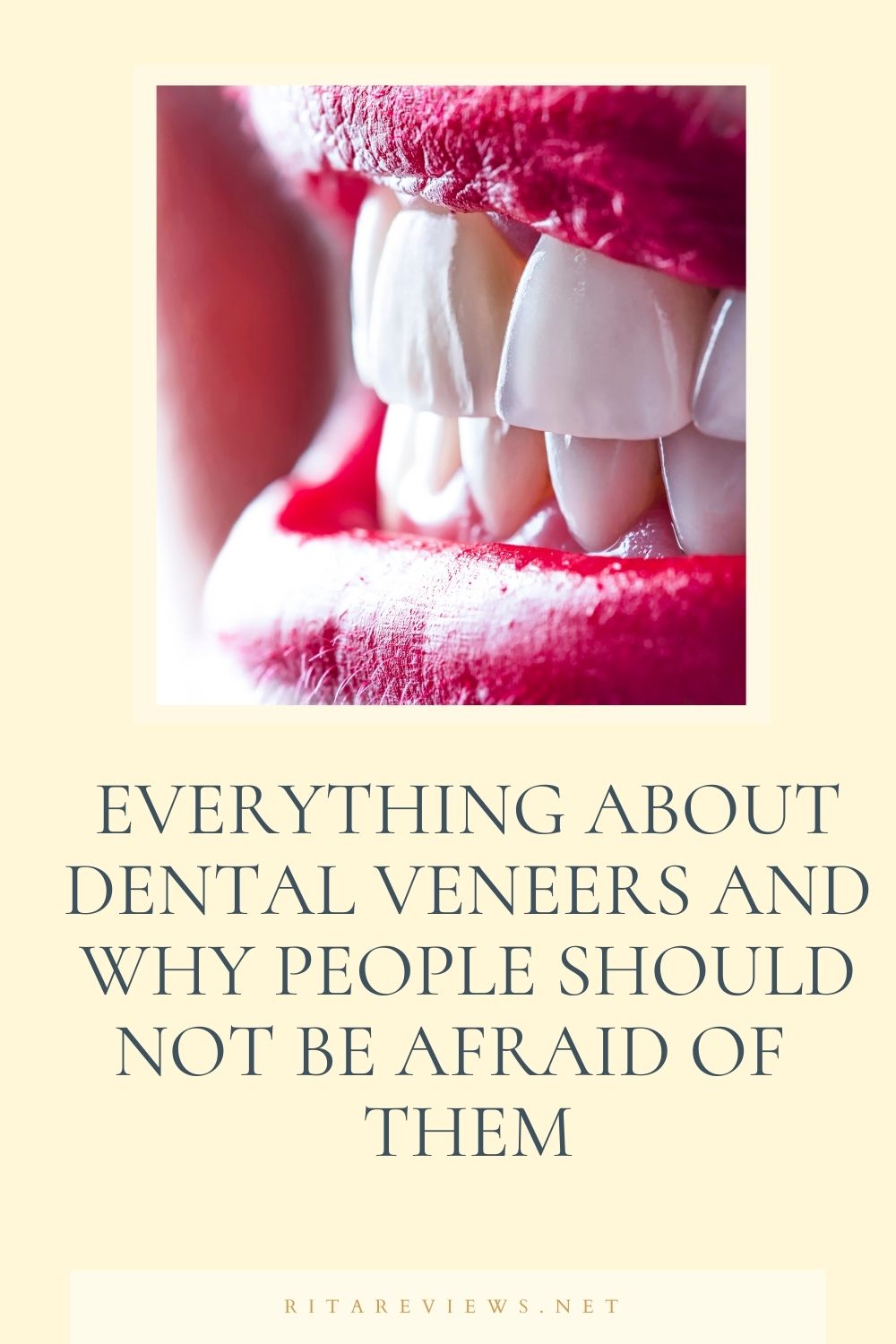 EVERYTHING ABOUT DENTAL VENEERS AND WHY PEOPLE SHOULD NOT BE AFRAID OF THEM