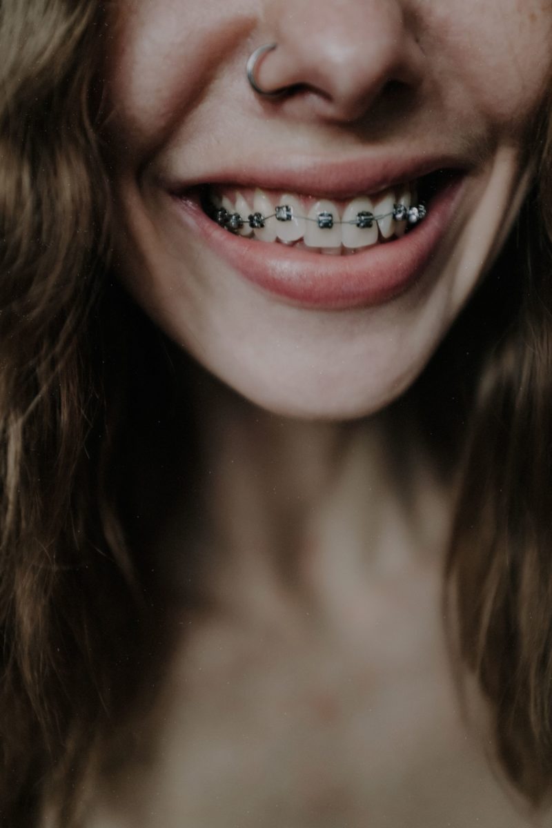 Top Tips For Wearing Braces