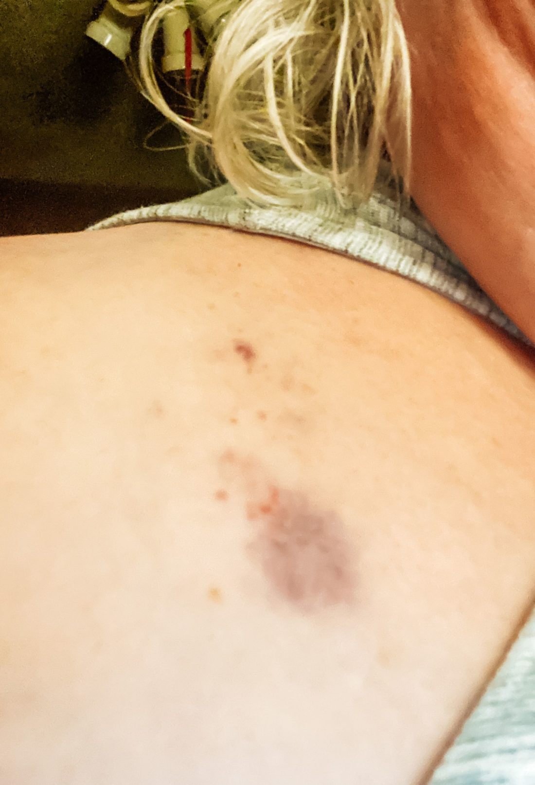 My Heart Cath Experience - chest bruise