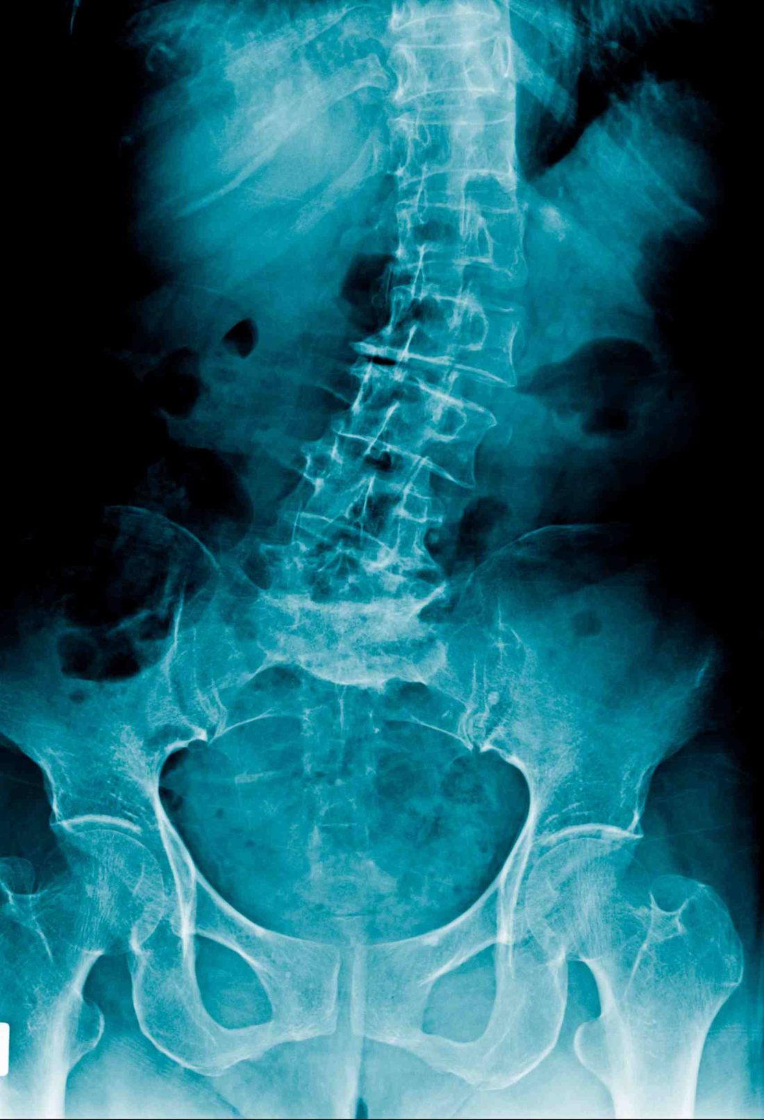 Top Non-Surgical Scoliosis Treatment Options