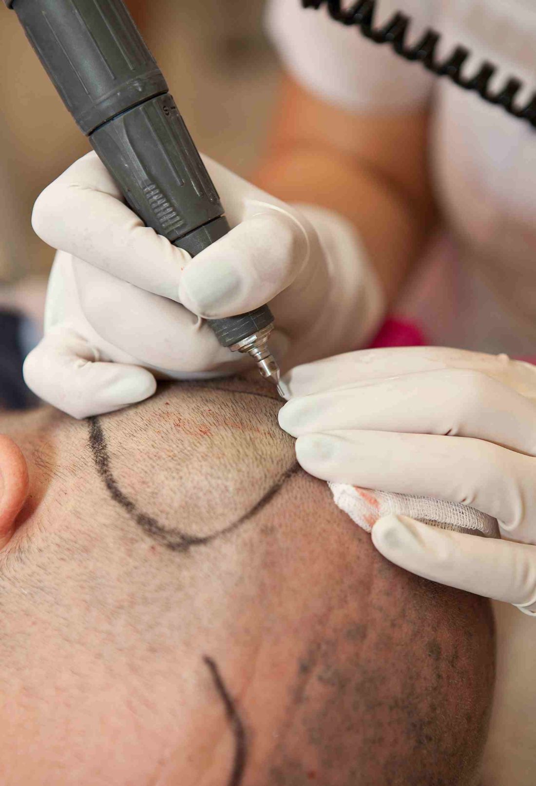 4 Essential Things to Know Before Getting a Hair Transplant