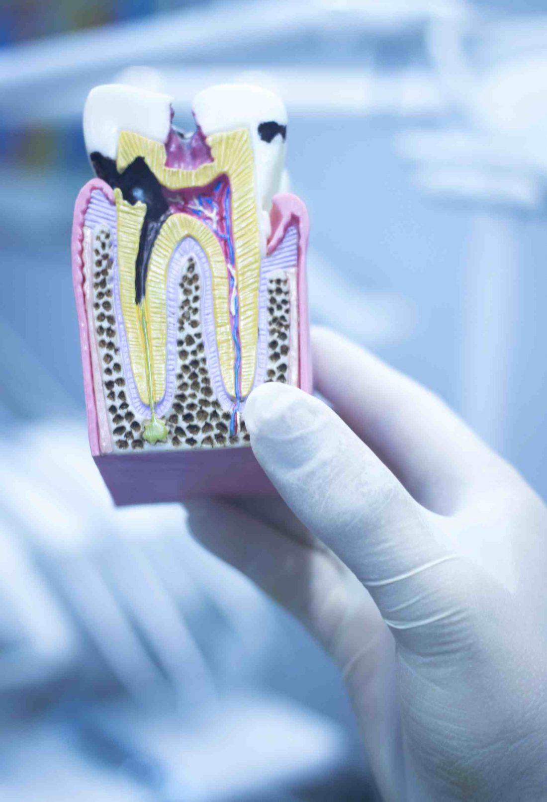 Preventing Tooth Decay: What Are the Top 5 Causes?