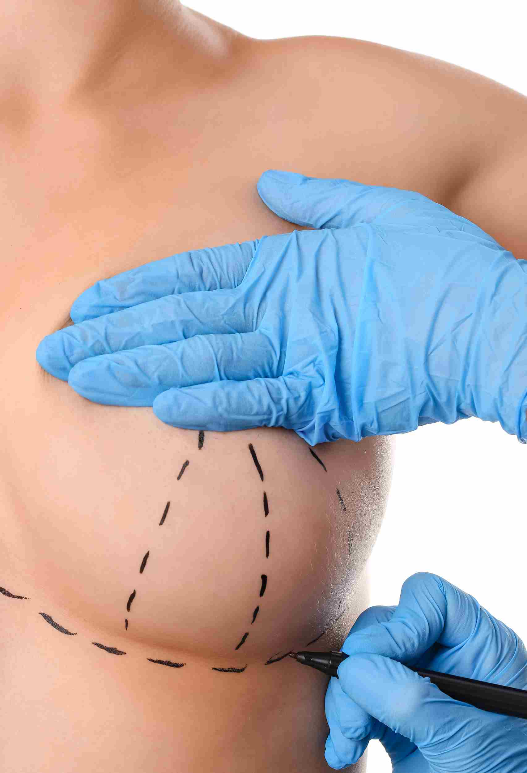 Breast Reconstruction All You Need to Know About Restoring Your Confidence and Body