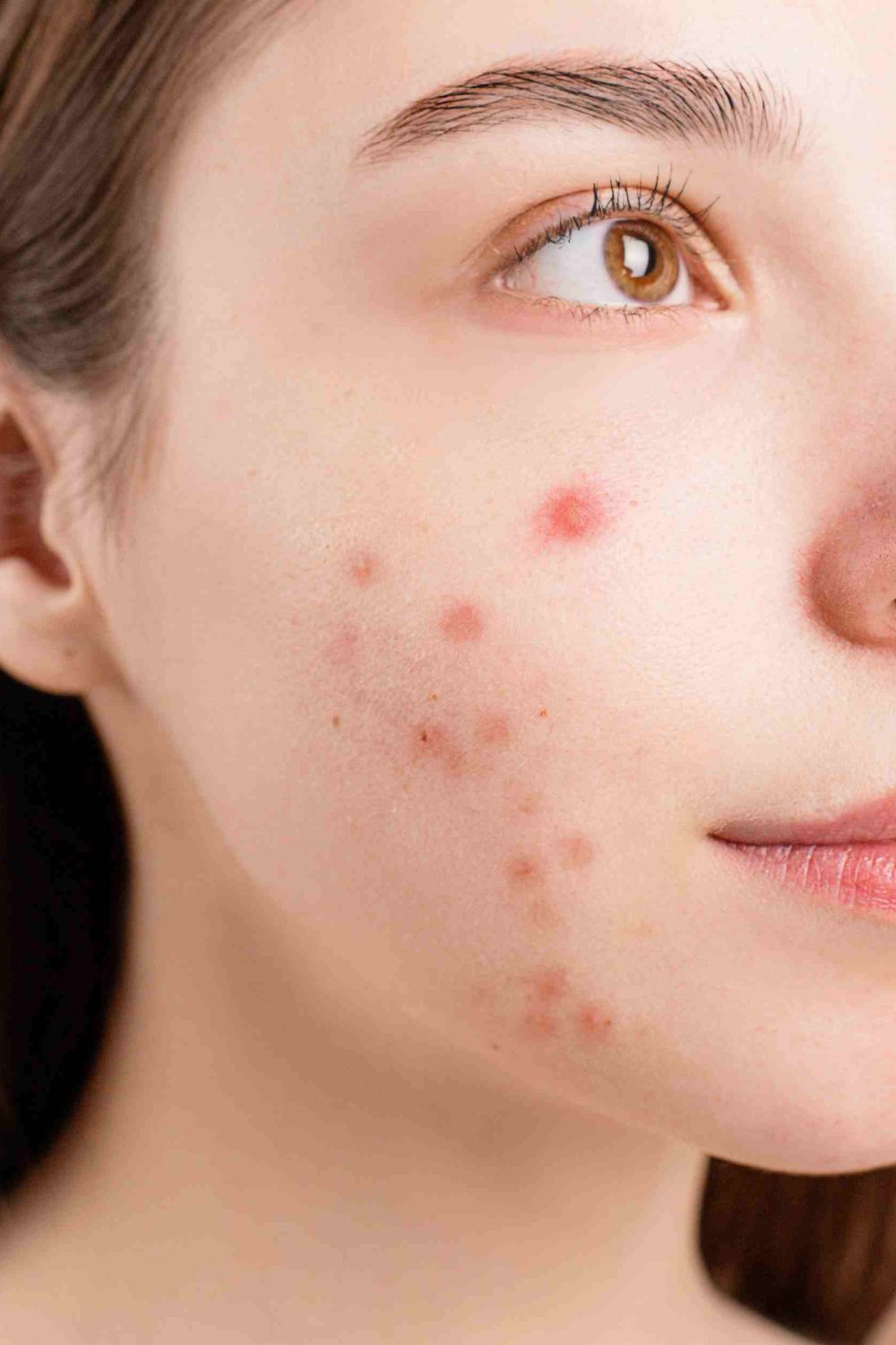 6 Things to Try If Your Acne Won't Clear