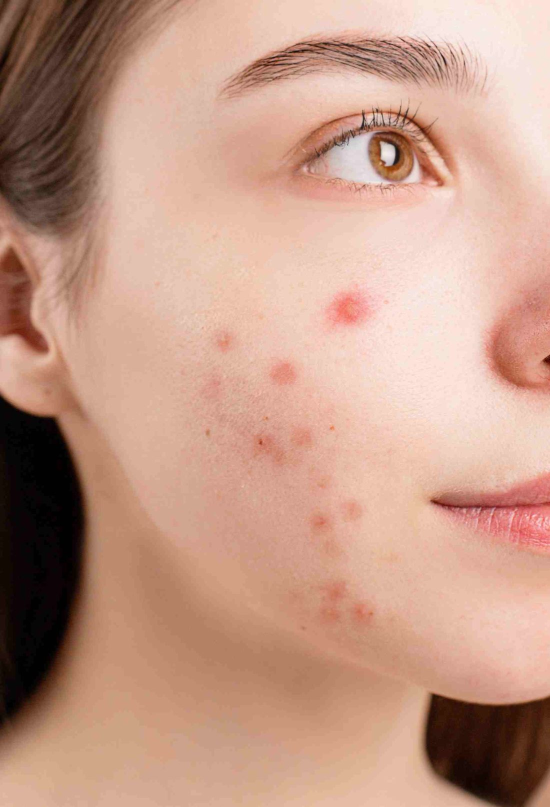 6 Things to Try If Your Acne Won't Clear