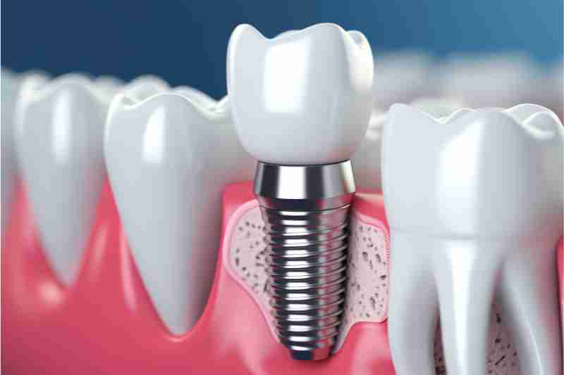Dental Implants Which One Is Right For You