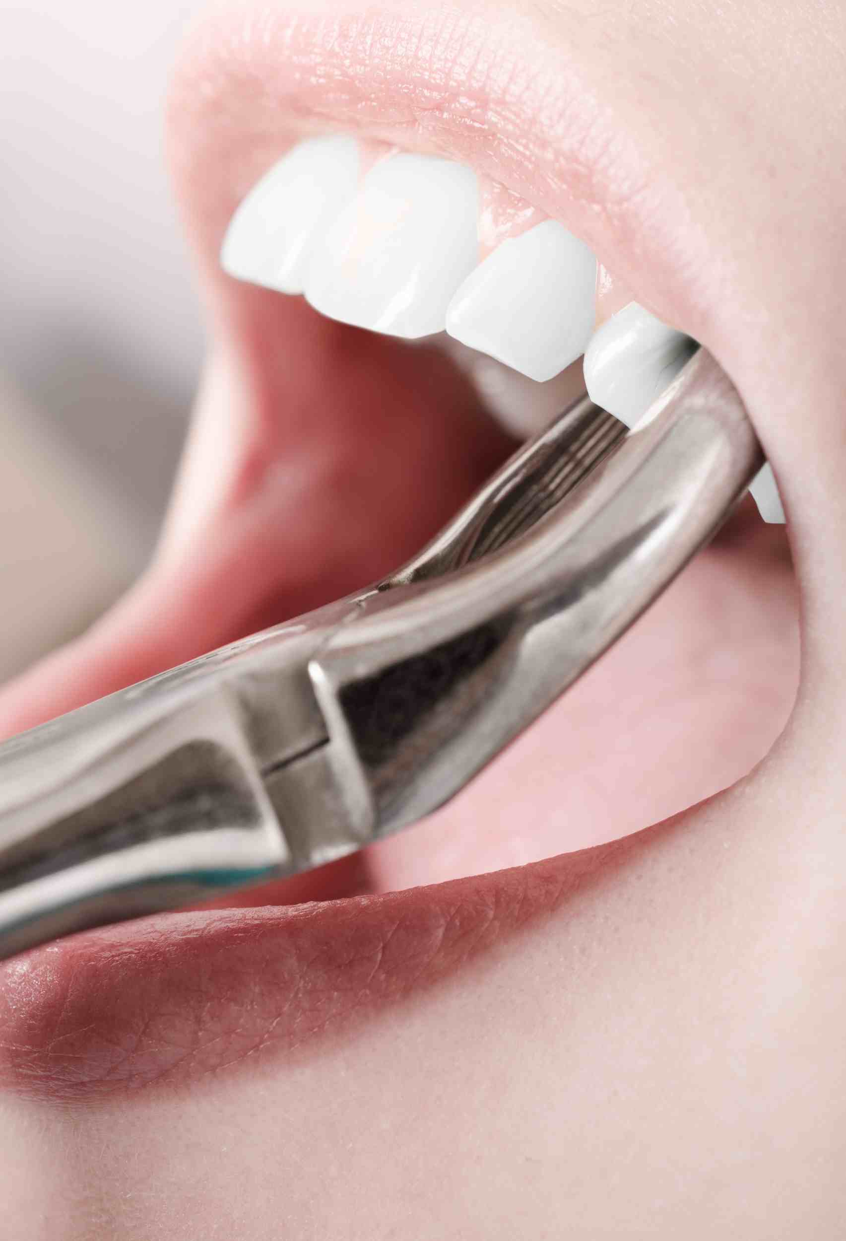 5 Signs You Might Need a Tooth Extraction (And What to Do Next)