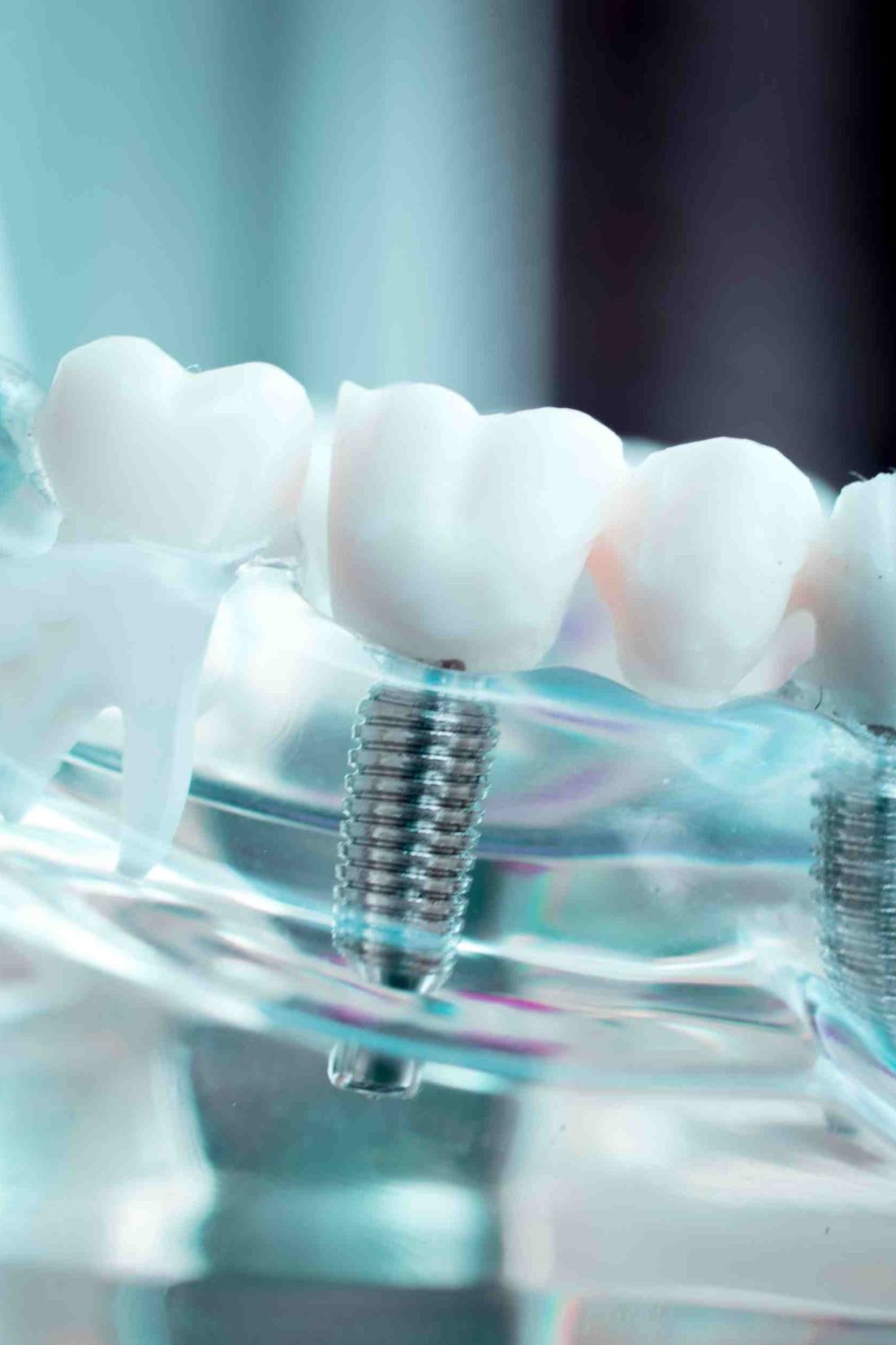 Unraveling the Lifecycle and Maintenance of Dental Implants
