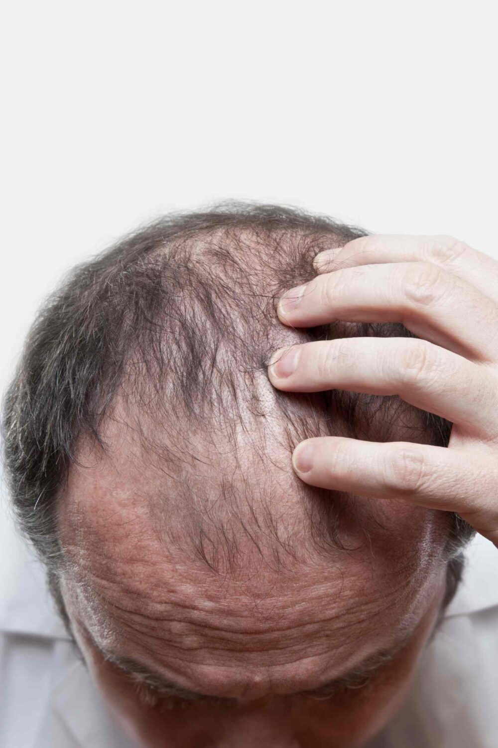 10 Things That Lead to Hair Loss in Men