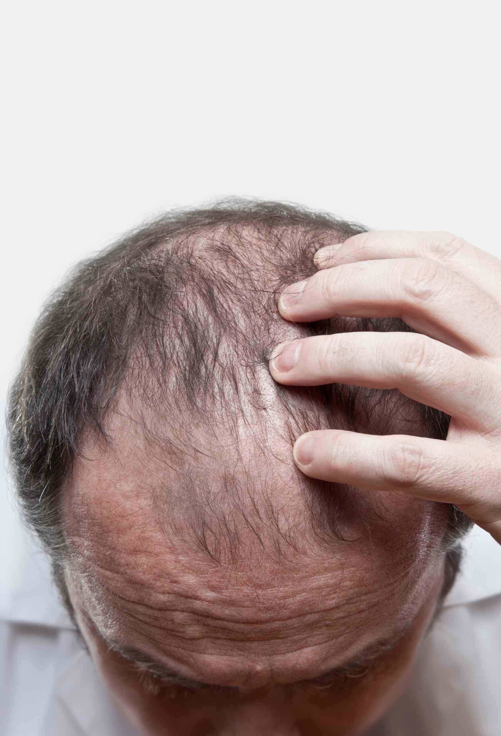 10 Things That Lead to Hair Loss in Men