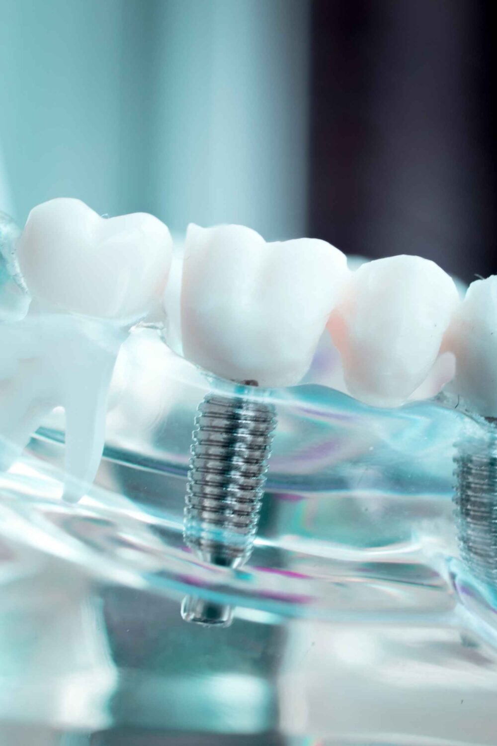 Is It Time for Dental Implants Recognizing the Signs of Tooth Loss