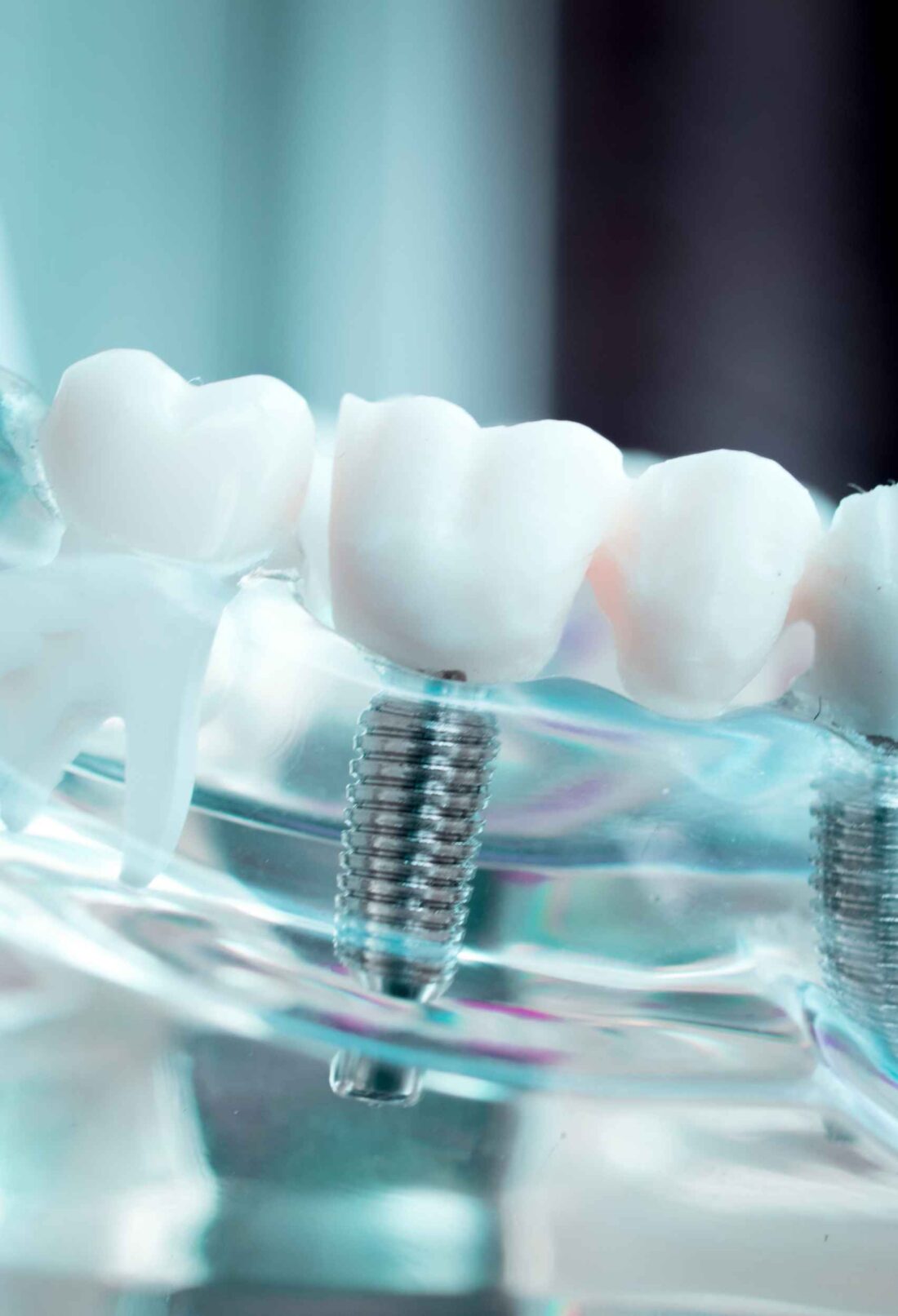 Is It Time for Dental Implants Recognizing the Signs of Tooth Loss