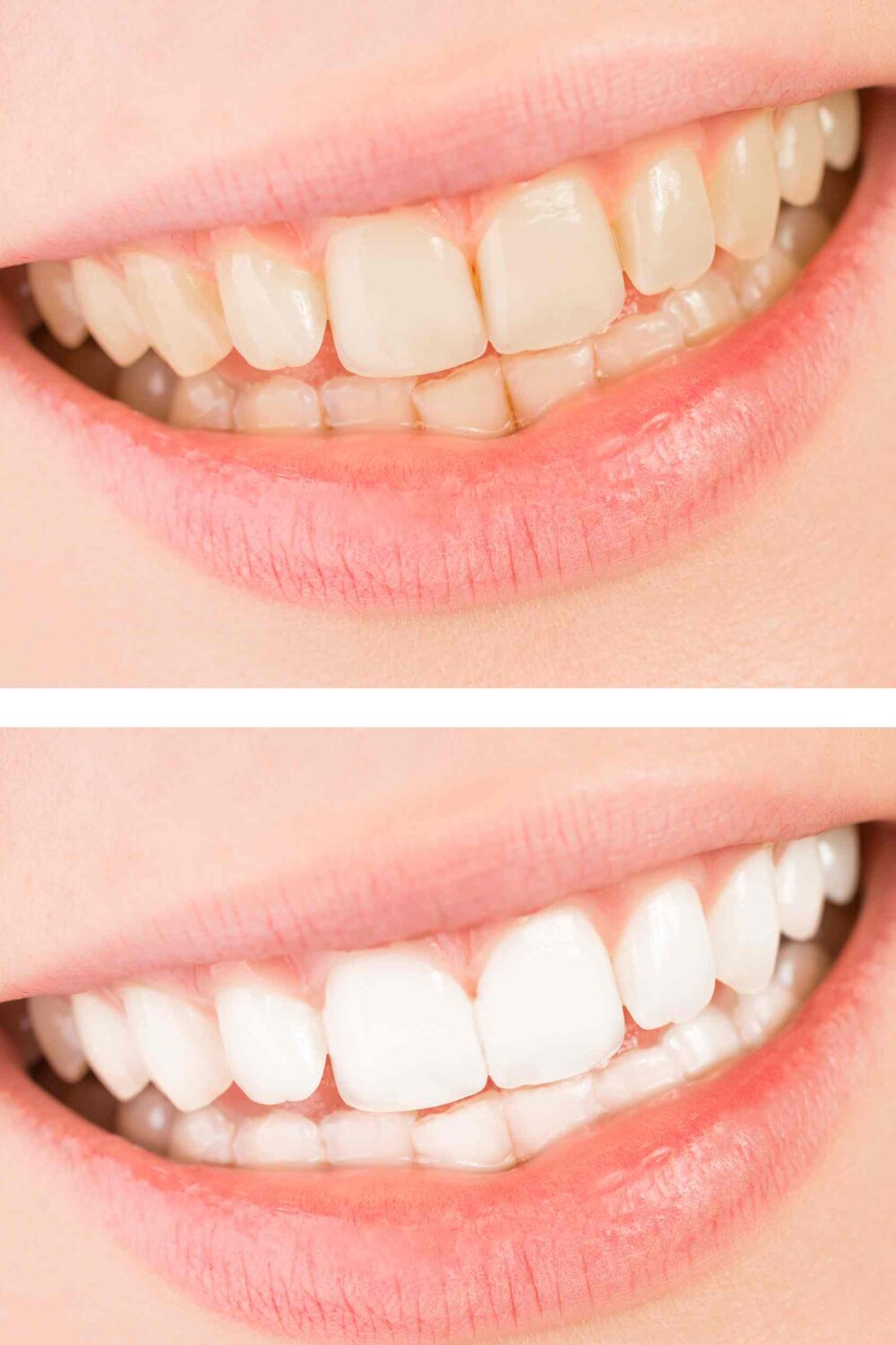 Beyond Aesthetics How Teeth Whitening in Sugar Land Improves Oral Health