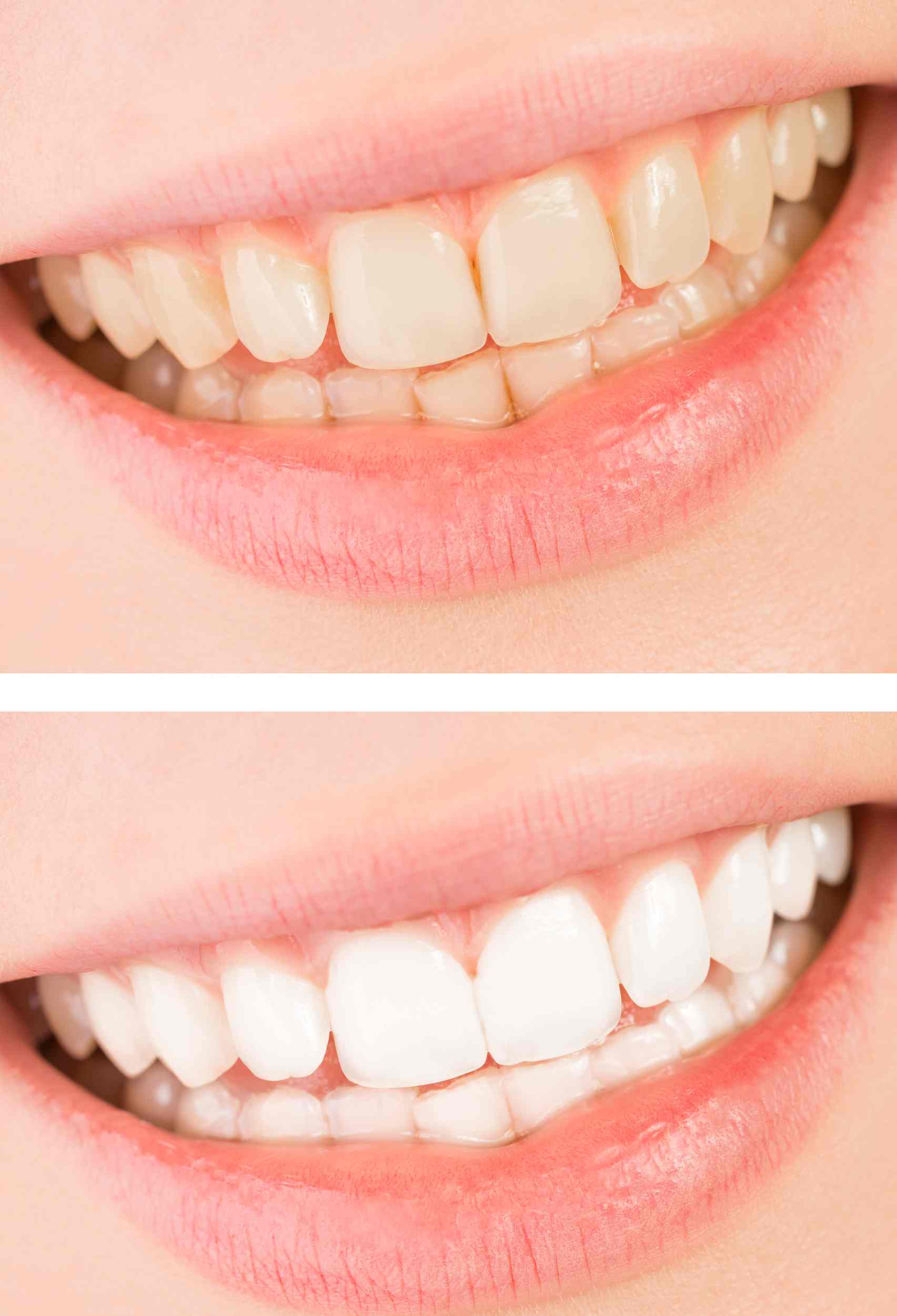 Beyond Aesthetics How Teeth Whitening in Sugar Land Improves Oral Health