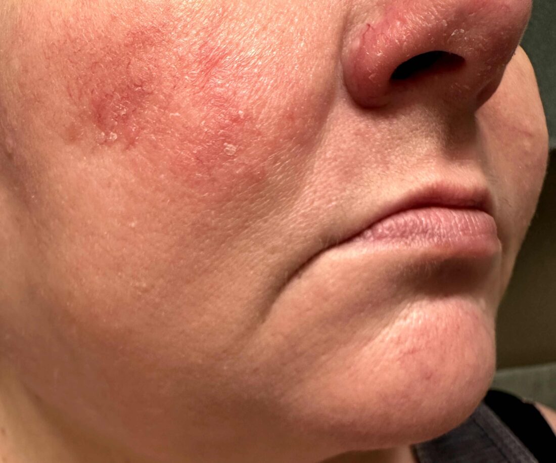 rosacea for Your Skin review