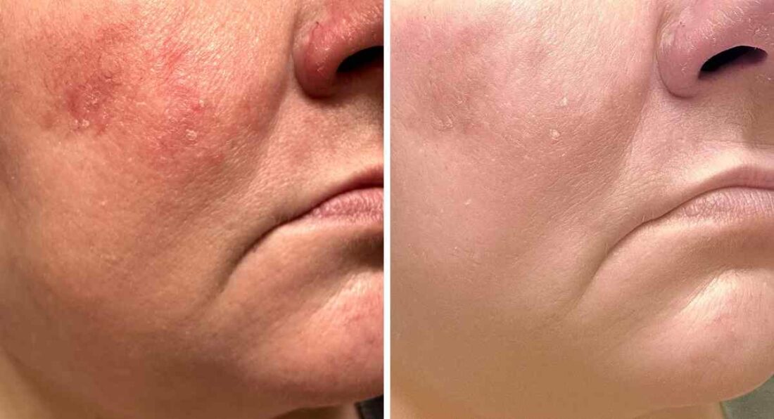 Your Skin Before and After