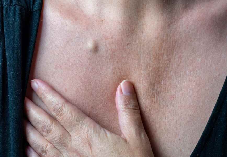 Why Removing A Lump Is Not Always Treating It
