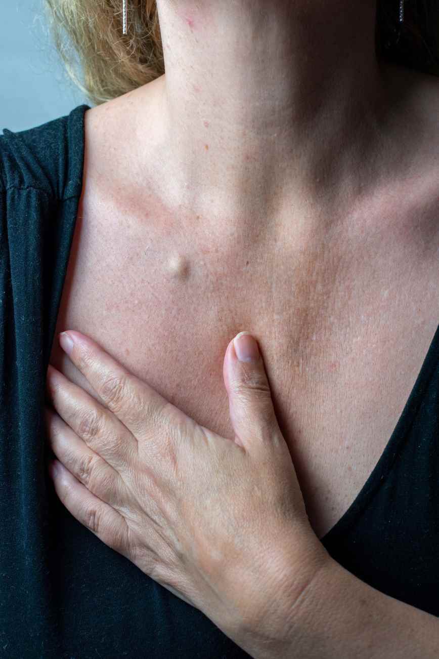 Why Removing A Lump Is Not Always Treating It
