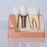 Helping a Loved One Prepare for Dental Implant Treatment