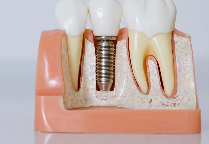 Helping a Loved One Prepare for Dental Implant Treatment