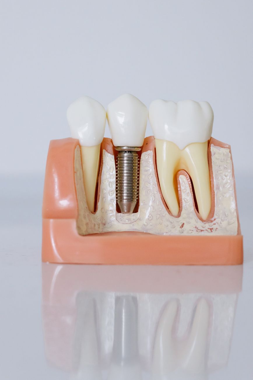 Helping a Loved One Prepare for Dental Implant Treatment