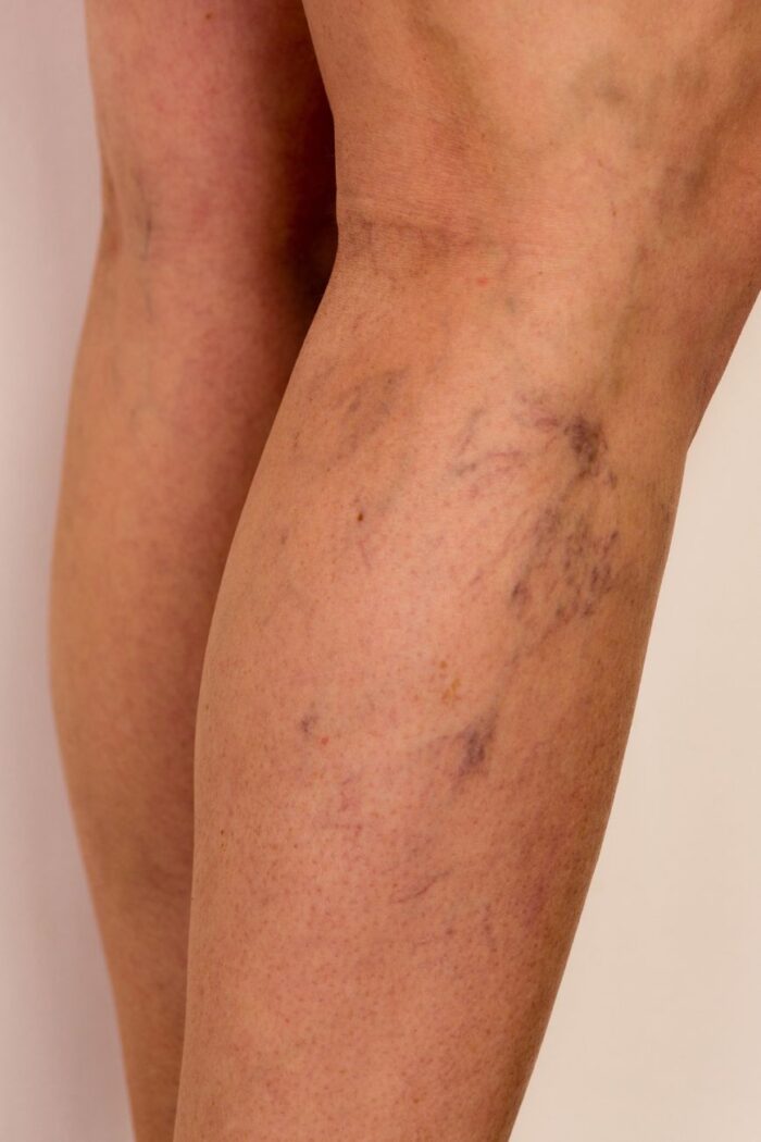 The Fragility Of The Human Vein Under Pressure