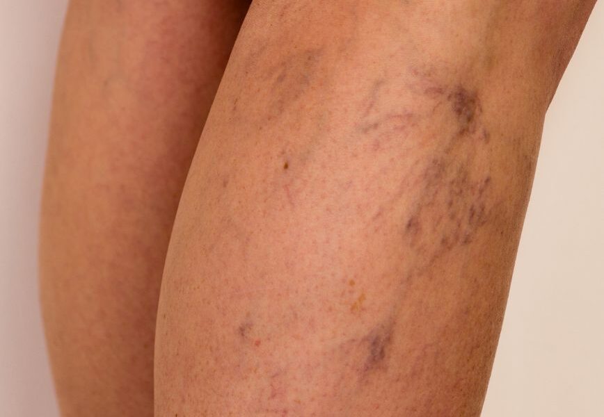 The Fragility Of The Human Vein Under Pressure