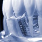 Top 6 Florida Providers for Zygomatic Implants for Severe Upper-Jaw Bone Loss