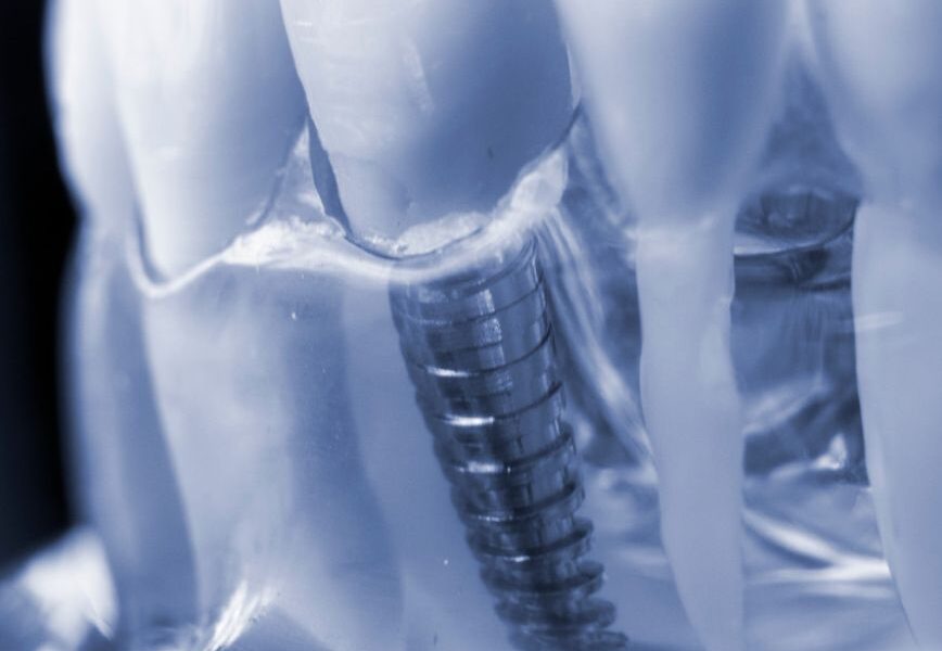 Top 6 Florida Providers for Zygomatic Implants for Severe Upper-Jaw Bone Loss