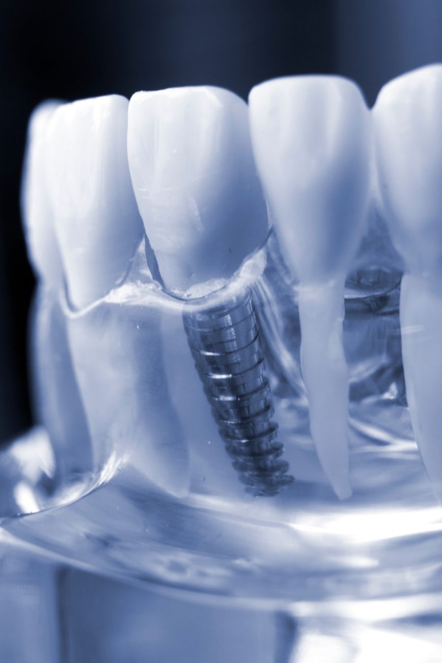 Top 6 Florida Providers for Zygomatic Implants for Severe Upper-Jaw Bone Loss